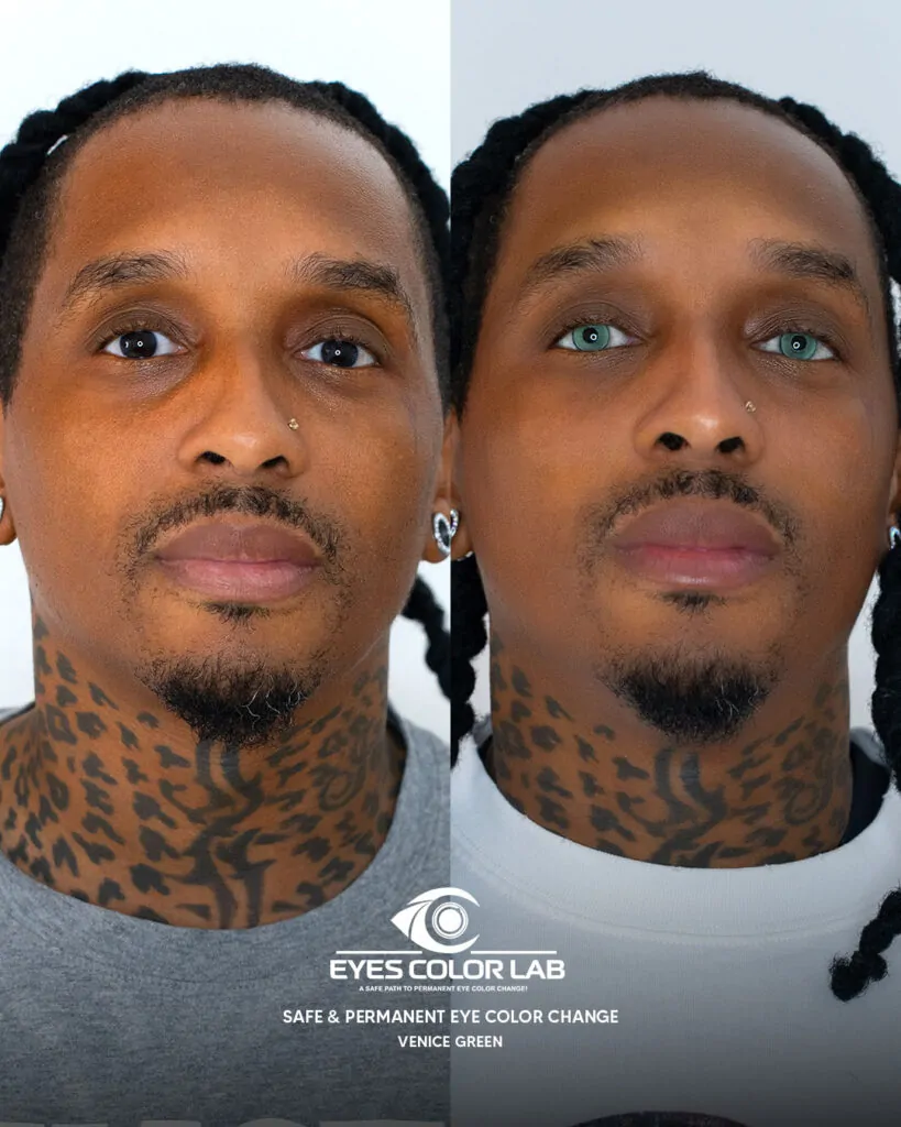 ecl-before-after (10)