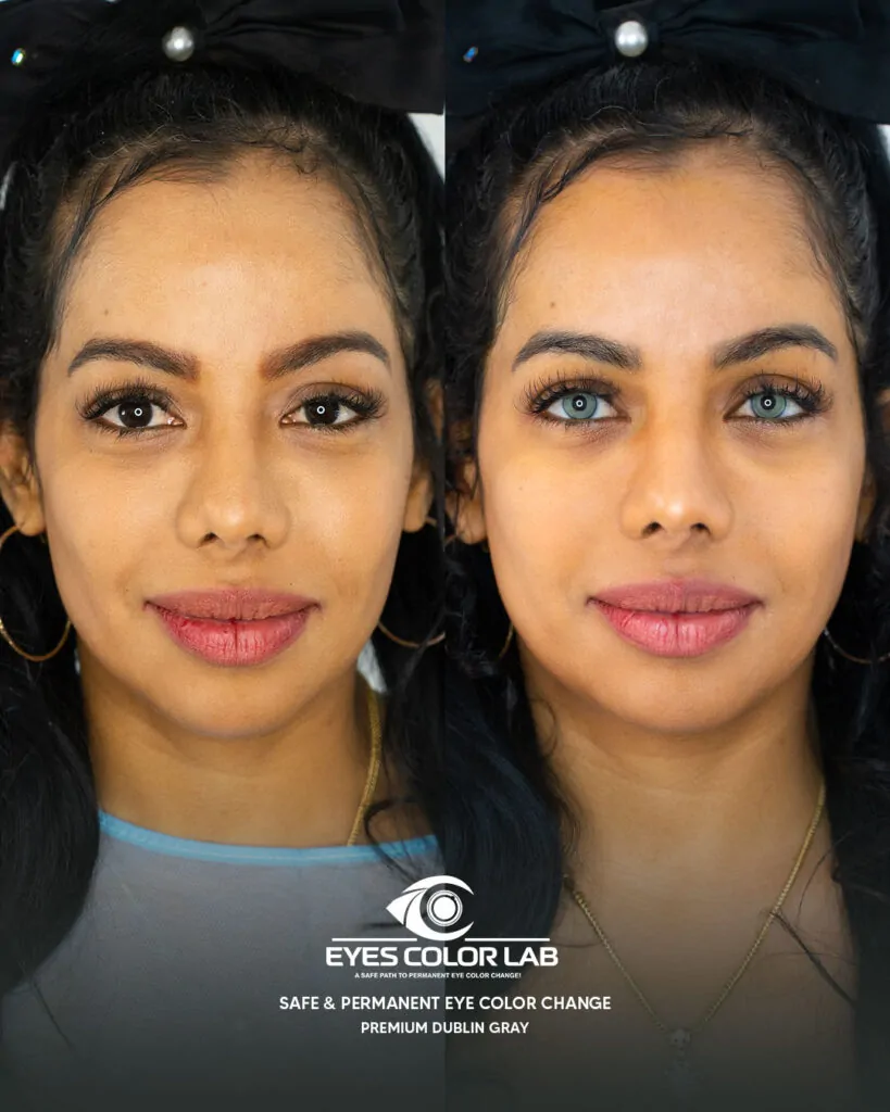 ecl-before-after (29)